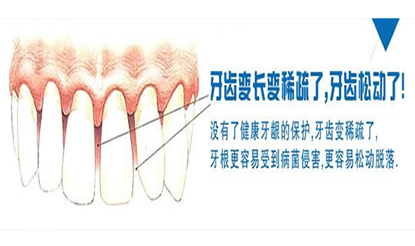 牙龈萎缩是怎么回事用什么牙膏才能恢复