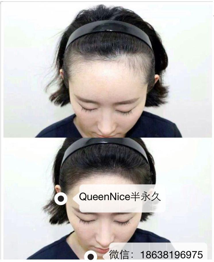 queennice半永久-填补发际线