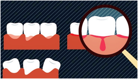 牙龈出血的五大原因 360美牙 透明矫正