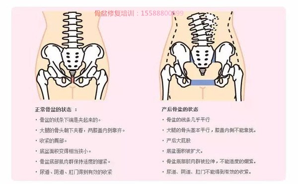 想要恢復好身材,那麼產後骨盆修復與盆底肌如何修復