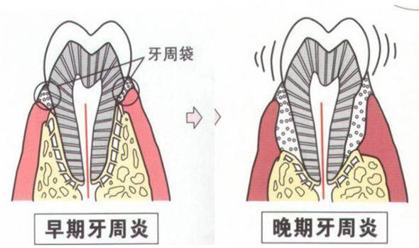 牙周炎应该用什么牙膏和牙刷?