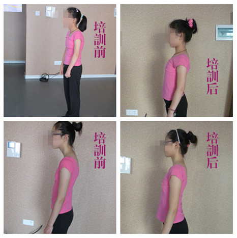 丁字桥学生形体气质课程含胸驼背包矫正